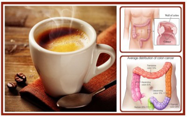 How Drinking Coffee Daily can Reduce Your Chances of Getting Colon Cancer